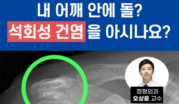 내 어깨 안에 돌? '석회성 건염'을 아시나요?